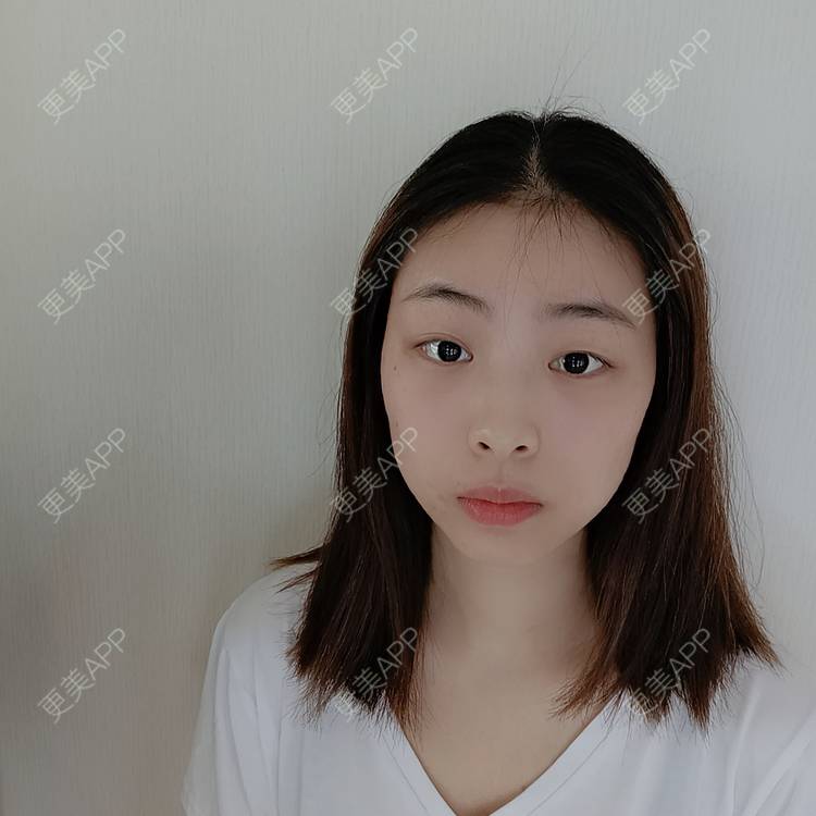 更美 - 蔓蔓青萝-的双眼皮经验 | 双眼皮 | 开内眼角 | 内切去眼袋 | 重庆