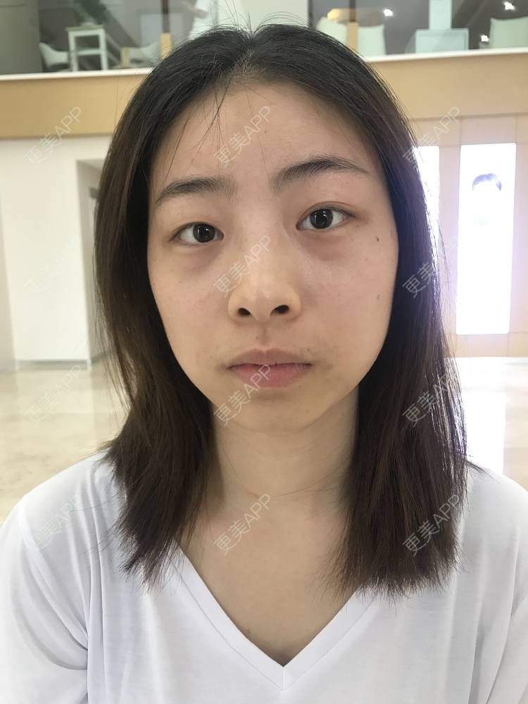 更美 - 蔓蔓青萝-的双眼皮经验 | 双眼皮 | 开内眼角 | 内切去眼袋 | 重庆