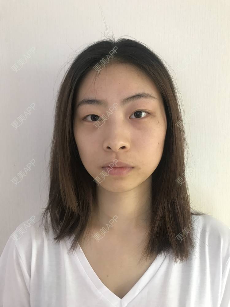 更美 - 蔓蔓青萝-的双眼皮经验 | 双眼皮 | 开内眼角 | 内切去眼袋 | 重庆