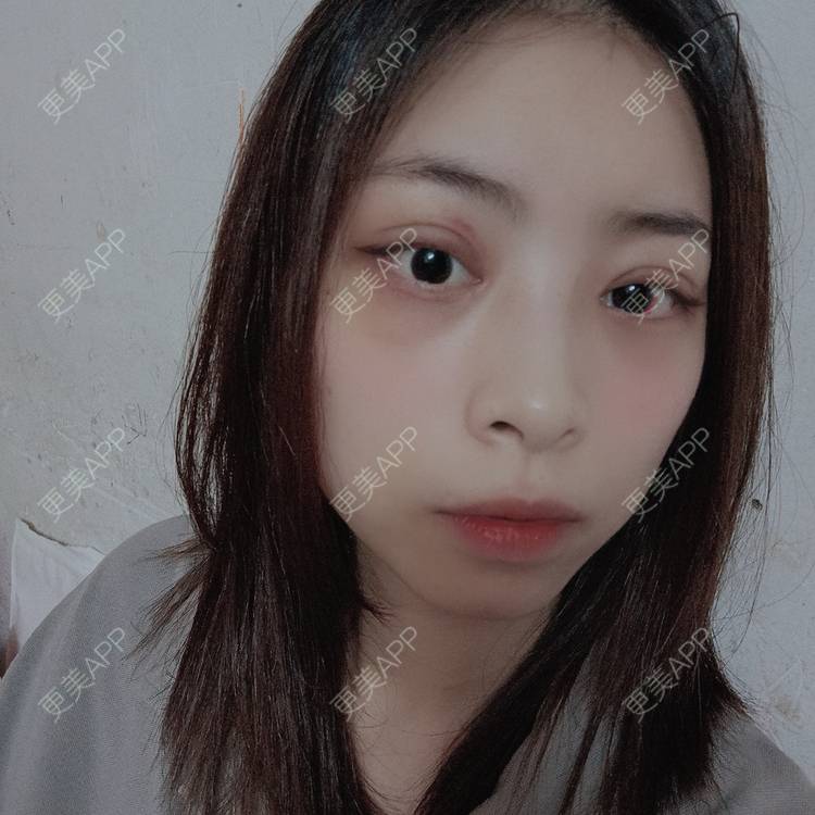 更美 - 蔓蔓青萝-的双眼皮经验 | 双眼皮 | 开内眼角 | 内切去眼袋 | 重庆