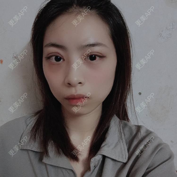 更美 - 蔓蔓青萝-的双眼皮经验 | 双眼皮 | 开内眼角 | 内切去眼袋 | 重庆