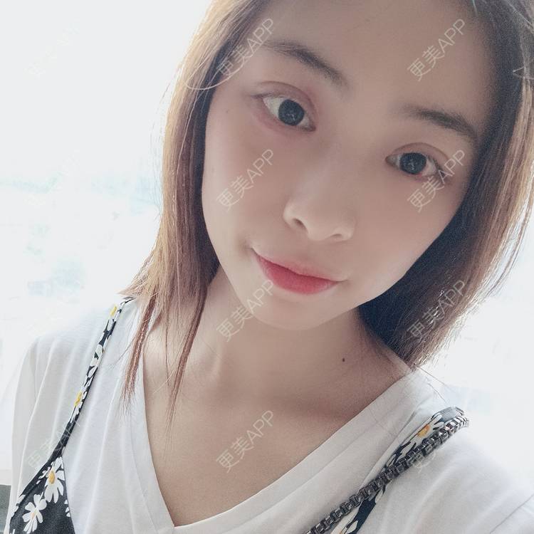 更美 - 蔓蔓青萝-的双眼皮经验 | 双眼皮 | 开内眼角 | 内切去眼袋 | 重庆