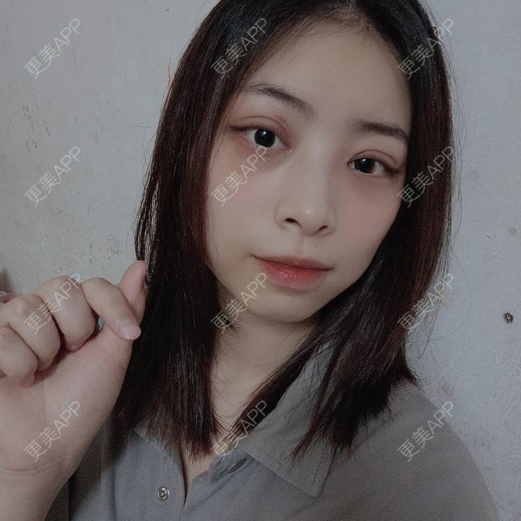 更美 - 蔓蔓青萝-的双眼皮经验 | 双眼皮 | 开内眼角 | 内切去眼袋 | 重庆