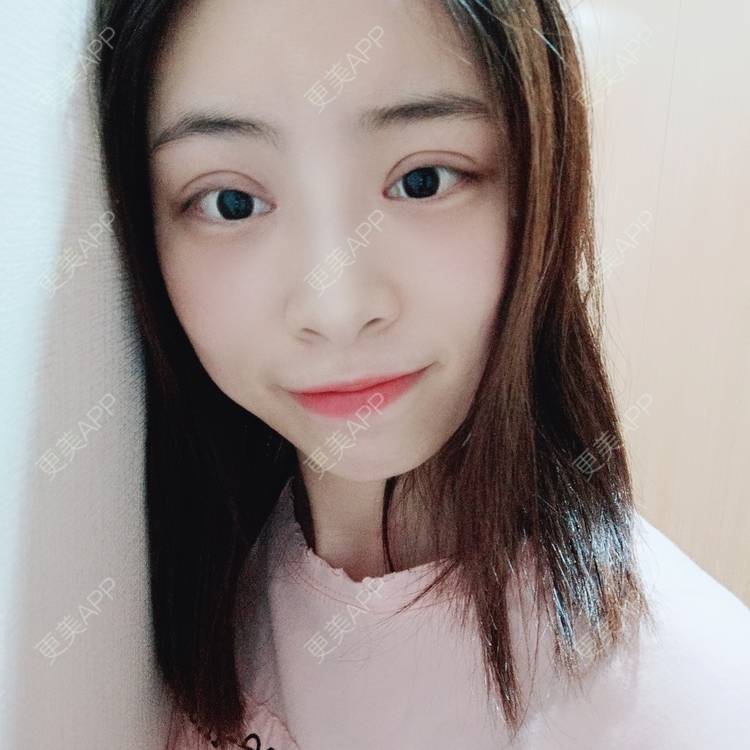 更美 - 蔓蔓青萝-的双眼皮经验 | 双眼皮 | 开内眼角 | 内切去眼袋 | 重庆