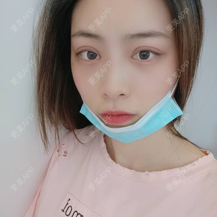 更美 - 蔓蔓青萝-的双眼皮经验 | 双眼皮 | 开内眼角 | 内切去眼袋 | 重庆