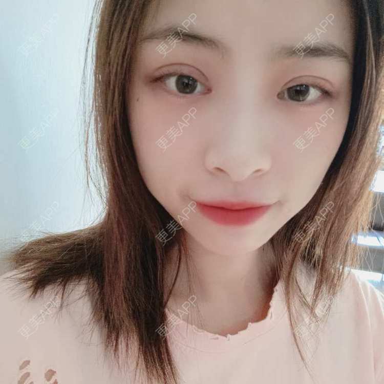 更美 - 蔓蔓青萝-的双眼皮经验 | 双眼皮 | 开内眼角 | 内切去眼袋 | 重庆