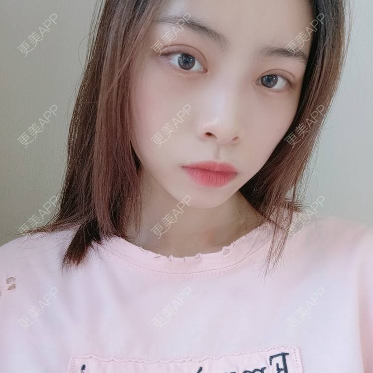 更美 - 蔓蔓青萝-的双眼皮经验 | 双眼皮 | 开内眼角 | 内切去眼袋 | 重庆