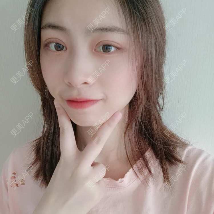 更美 - 蔓蔓青萝-的双眼皮经验 | 双眼皮 | 开内眼角 | 内切去眼袋 | 重庆