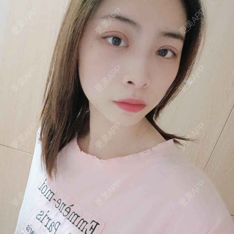 更美 - 蔓蔓青萝-的双眼皮经验 | 双眼皮 | 开内眼角 | 内切去眼袋 | 重庆
