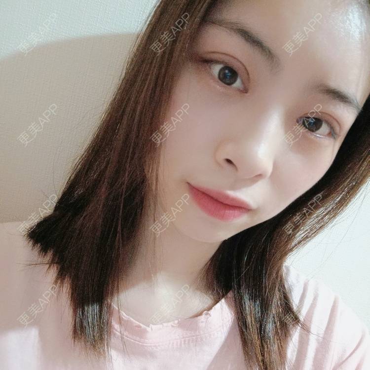 更美 - 蔓蔓青萝-的双眼皮经验 | 双眼皮 | 开内眼角 | 内切去眼袋 | 重庆