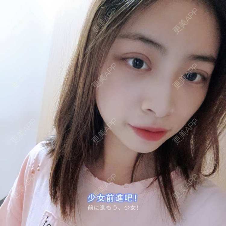 更美 - 蔓蔓青萝-的双眼皮经验 | 双眼皮 | 开内眼角 | 内切去眼袋 | 重庆