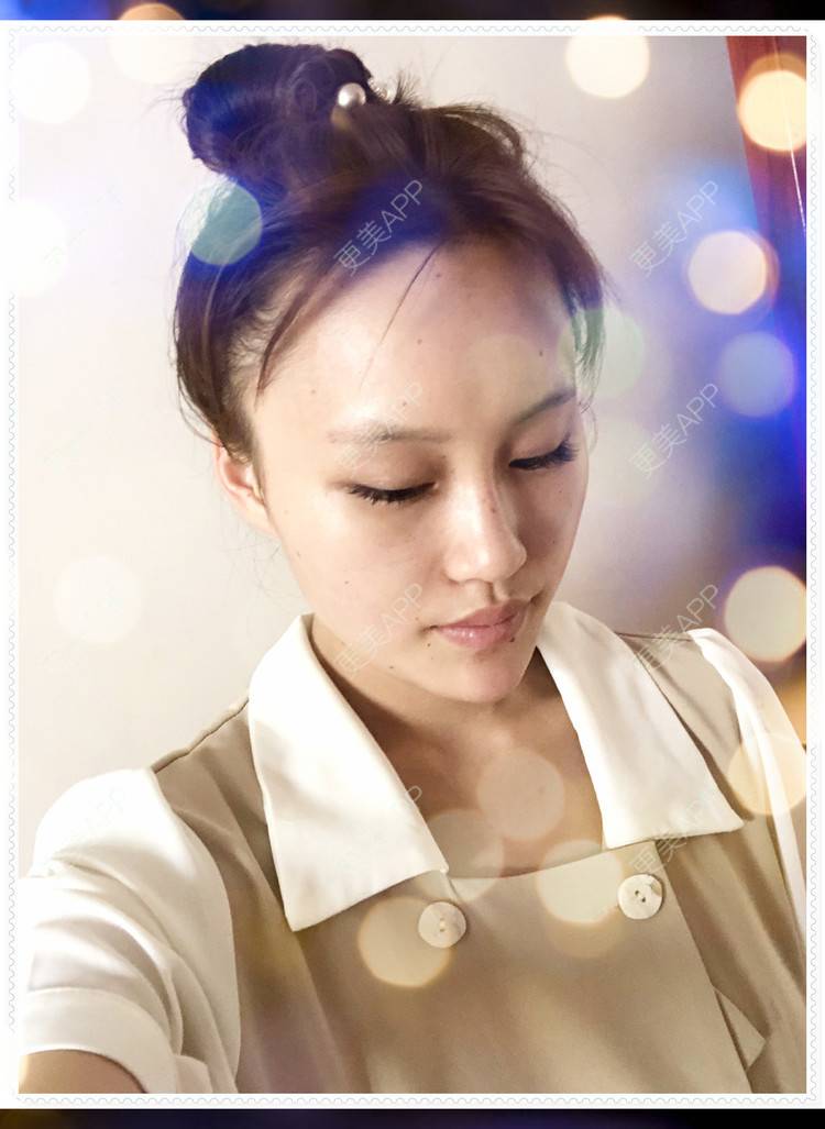 更美 - 更美用户8mS8cMiXpR的双眼皮经验 | 双眼皮 | 无锡
