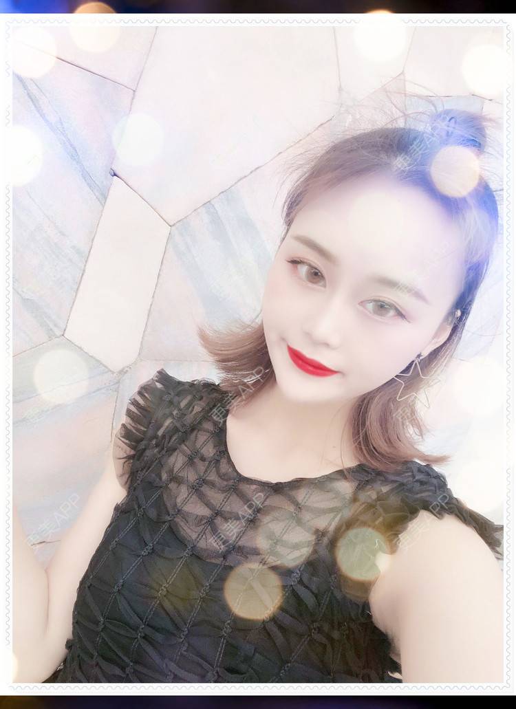 更美 - 更美用户8mS8cMiXpR的双眼皮经验 | 双眼皮 | 无锡
