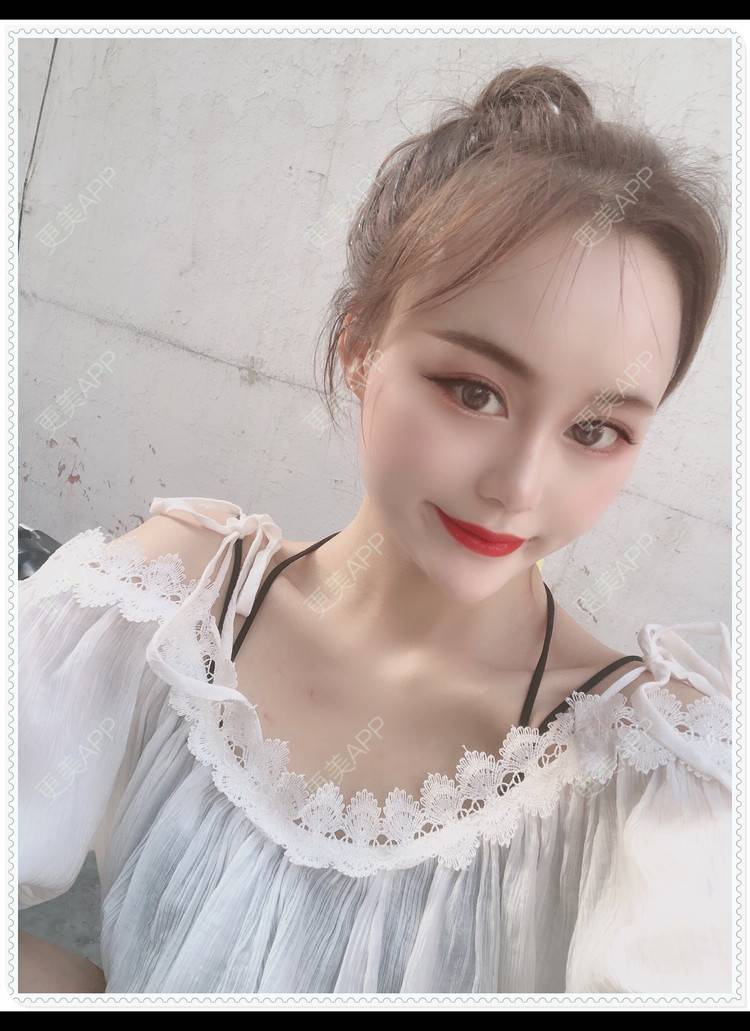 更美 - 更美用户8mS8cMiXpR的双眼皮经验 | 双眼皮 | 无锡