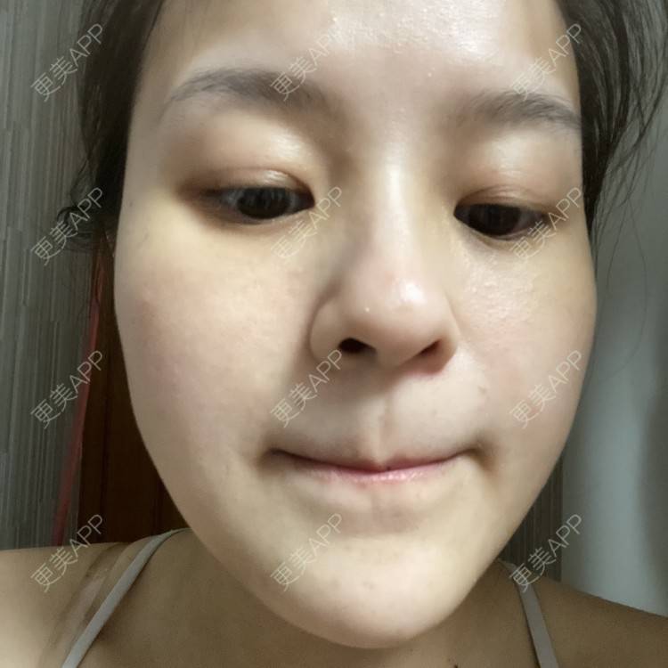 更美 - 一白遮三丑丑丑的激光淡斑经验 | 上海 | 激光淡斑 | 皮秒激光 | 淡斑套餐