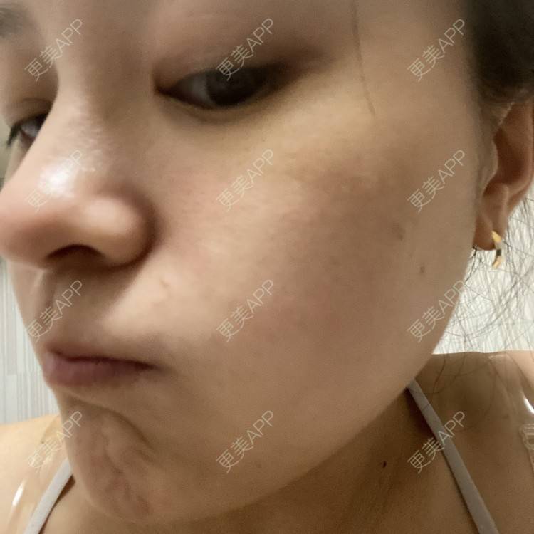 更美 - 一白遮三丑丑丑的激光淡斑经验 | 上海 | 激光淡斑 | 皮秒激光 | 淡斑套餐