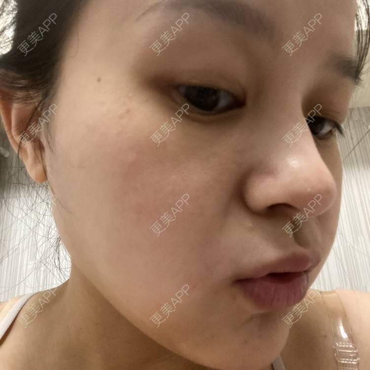 更美 - 一白遮三丑丑丑的激光淡斑经验 | 上海 | 激光淡斑 | 皮秒激光 | 淡斑套餐