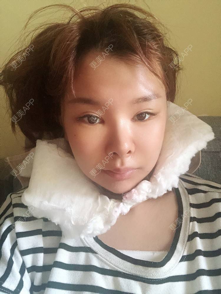 更美 - 更美用户WOuVgkC9NU的颧骨内推经验 | 颧骨内推 | 成都 | 颧弓降低