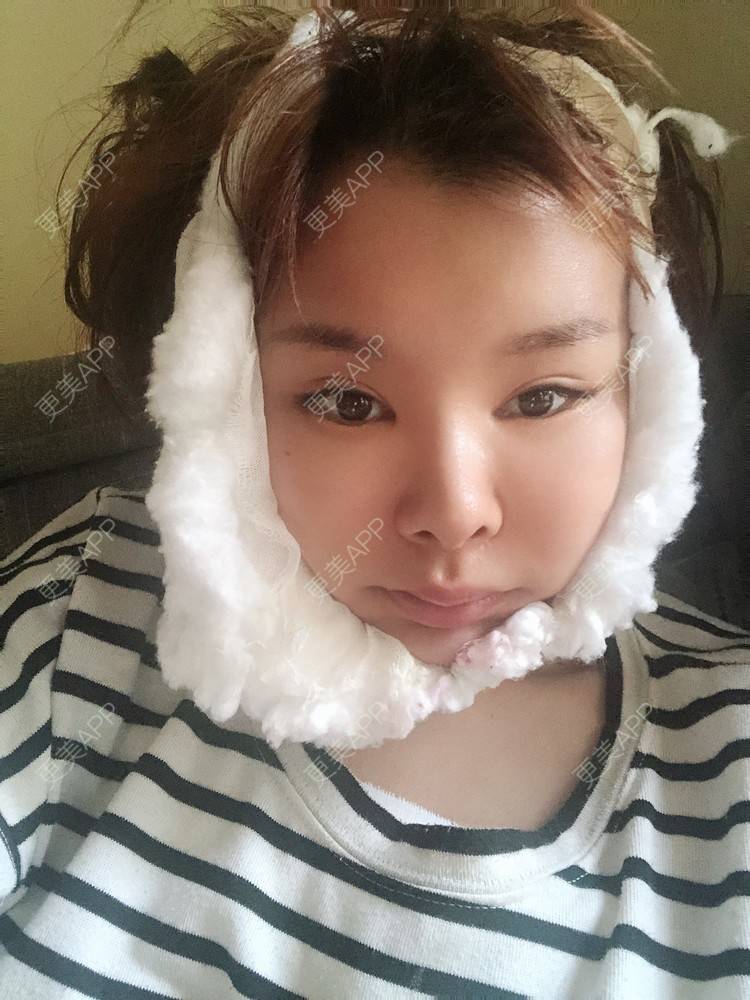 更美 - 更美用户WOuVgkC9NU的颧骨内推经验 | 颧骨内推 | 成都 | 颧弓降低