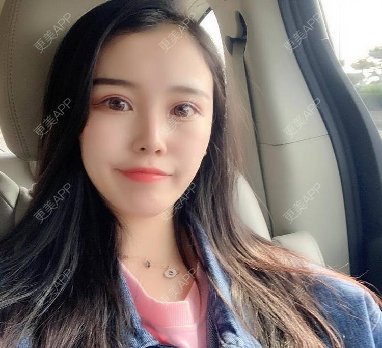 更美 - 更美用户xbfahwtDog的玻尿酸面部细纹经验 | 玻尿酸面部细纹