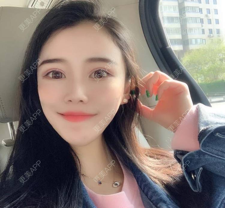 更美 - 更美用户xbfahwtDog的玻尿酸面部细纹经验 | 玻尿酸面部细纹