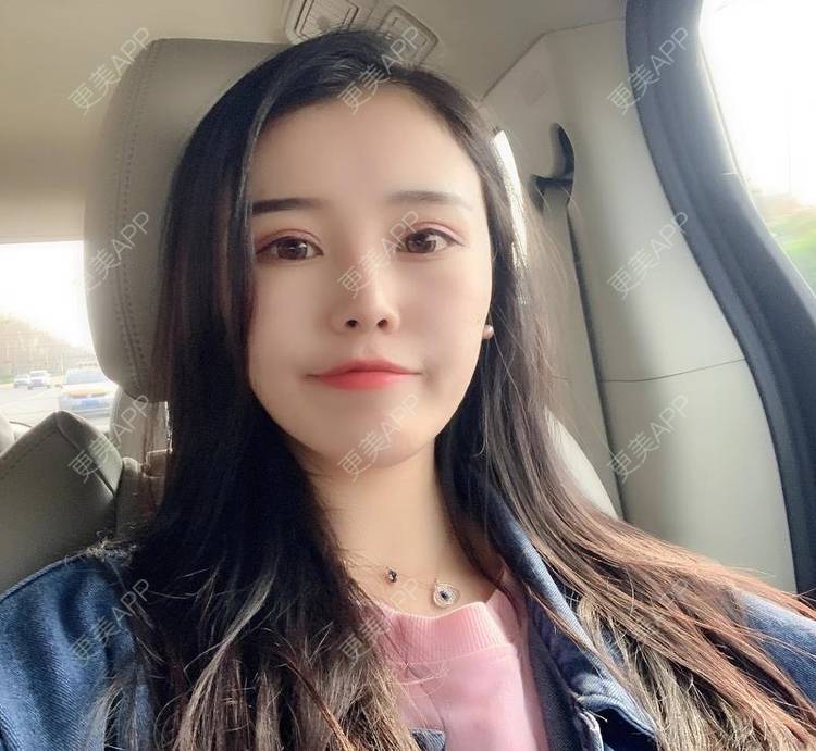 更美 - 更美用户xbfahwtDog的玻尿酸面部细纹经验 | 玻尿酸面部细纹