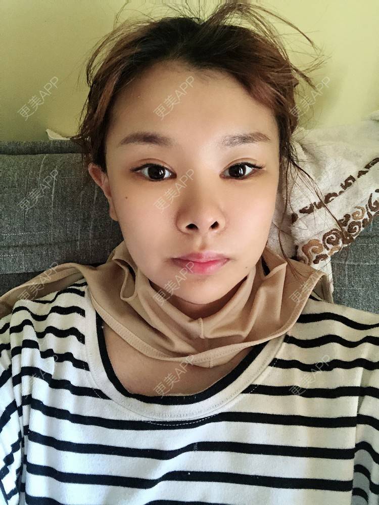 更美 - 更美用户WOuVgkC9NU的颧骨内推经验 | 颧骨内推 | 成都 | 颧弓降低