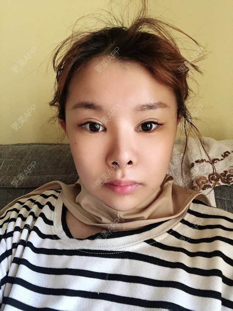 更美 - 更美用户WOuVgkC9NU的颧骨内推经验 | 颧骨内推 | 成都 | 颧弓降低