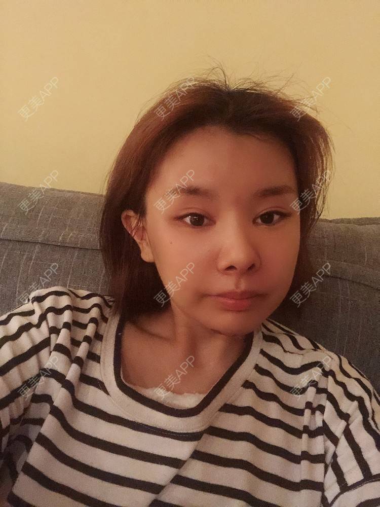 更美 - 更美用户WOuVgkC9NU的颧骨内推经验 | 颧骨内推 | 成都 | 颧弓降低
