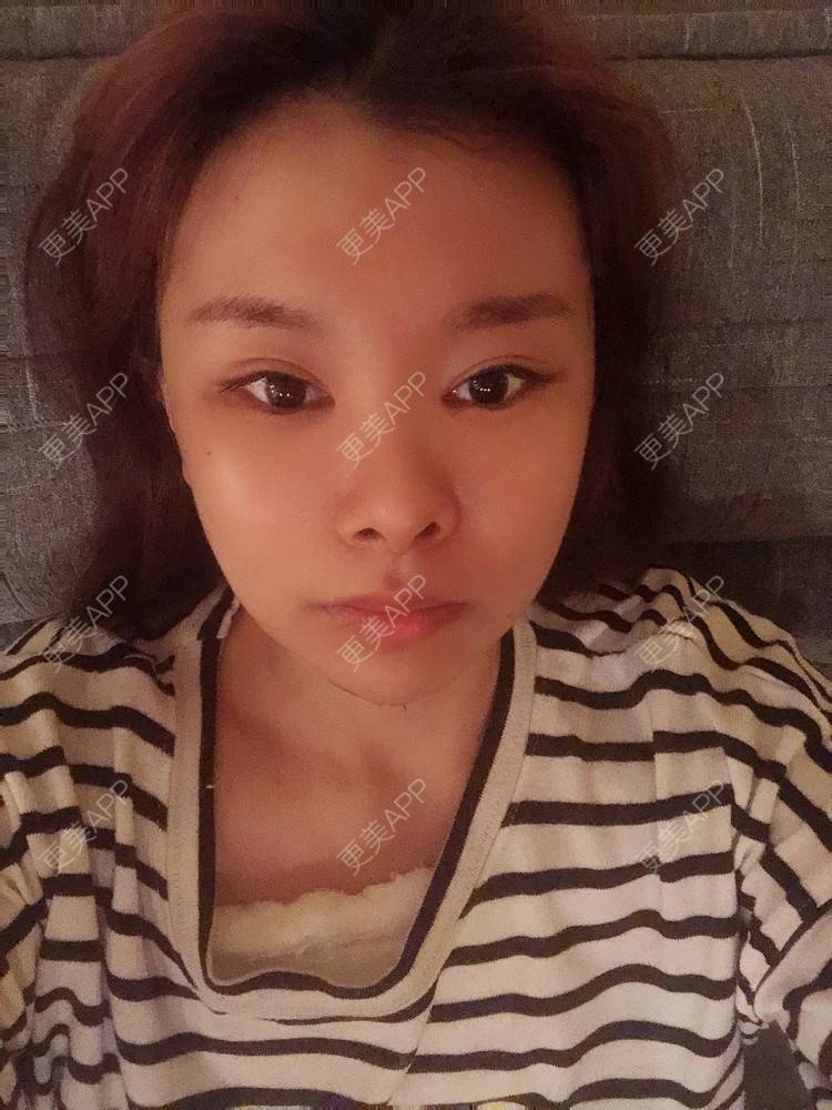 更美 - 更美用户WOuVgkC9NU的颧骨内推经验 | 颧骨内推 | 成都 | 颧弓降低