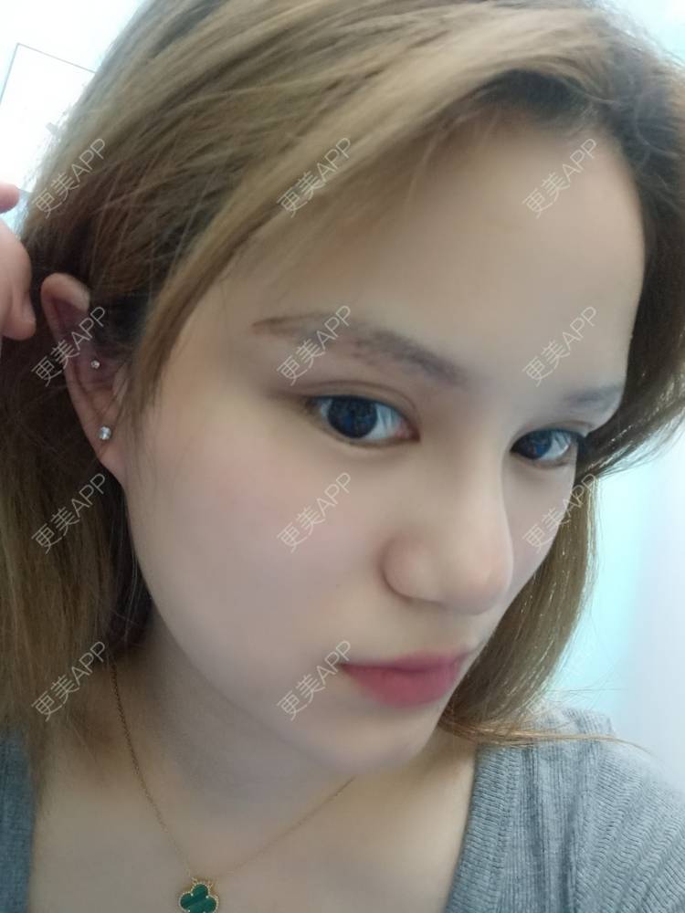 更美 - 路上有亻的激光洗眉经验 | 上海 | 激光洗眉