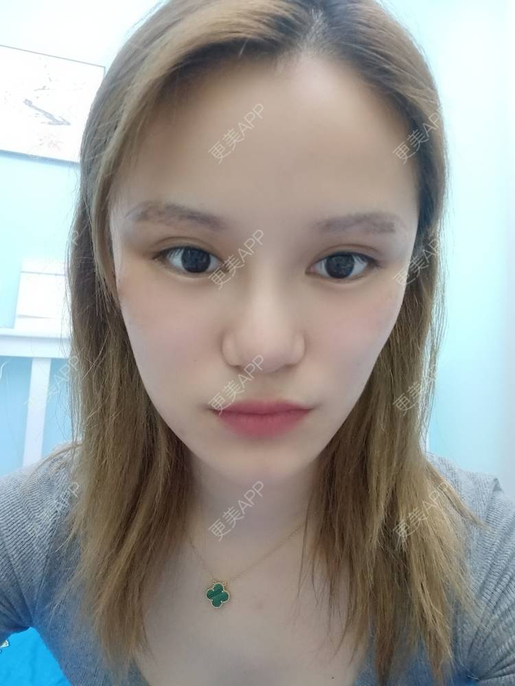 更美 - 路上有亻的激光洗眉经验 | 上海 | 激光洗眉
