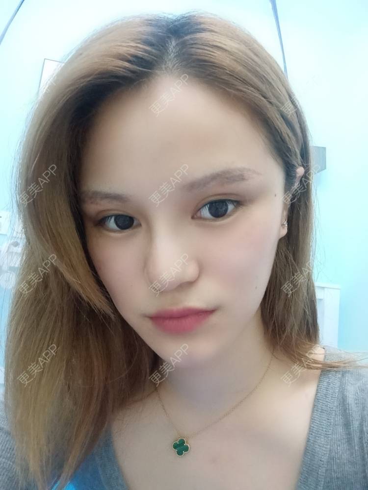 更美 - 路上有亻的激光洗眉经验 | 上海 | 激光洗眉