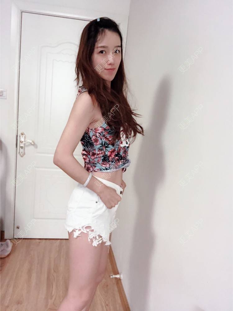 更美 - 美颖纯纯爱的冷冻溶脂经验 | 上海 | 冷冻溶脂