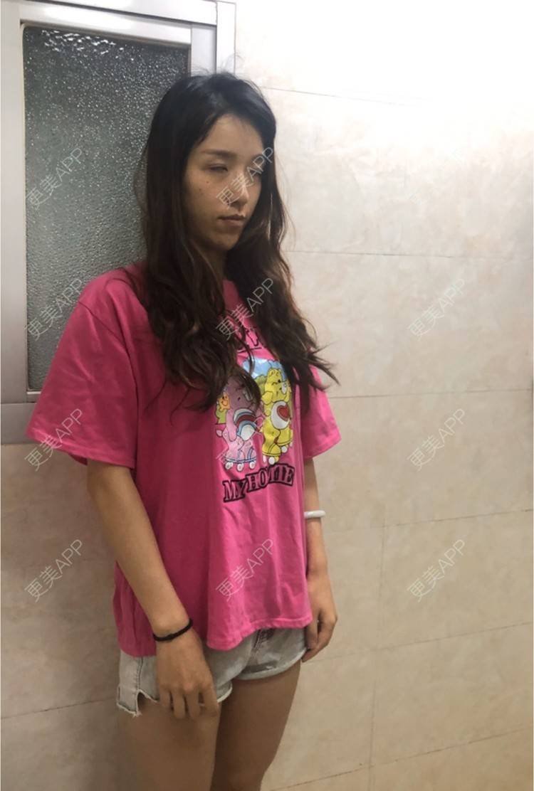 更美 - 美颖纯纯爱的冷冻溶脂经验 | 上海 | 冷冻溶脂