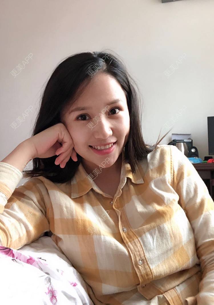 更美 - 更美用户R6xSXj7DGy的埋线提升经验 | 埋线提升 | 广州
