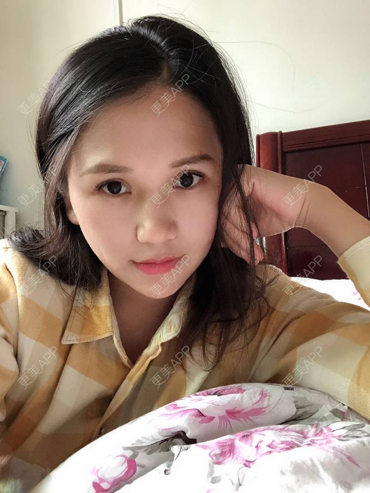 更美 - 更美用户R6xSXj7DGy的埋线提升经验 | 埋线提升 | 广州