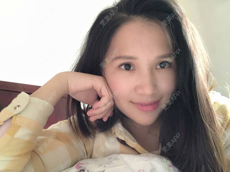 更美 - 更美用户R6xSXj7DGy的埋线提升经验 | 埋线提升 | 广州