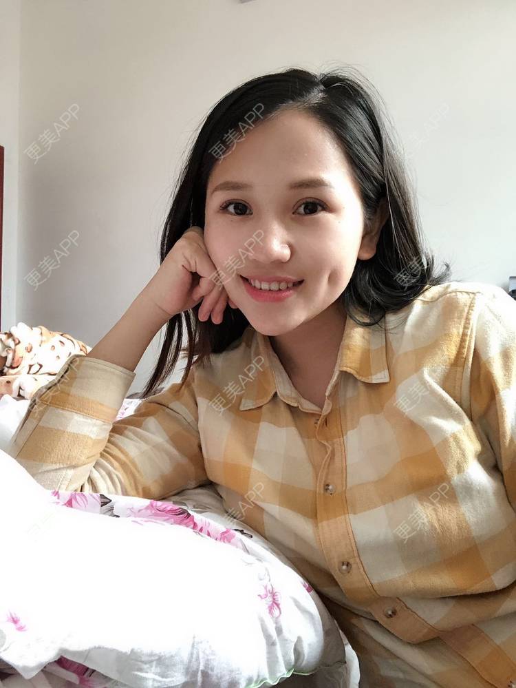更美 - 更美用户R6xSXj7DGy的埋线提升经验 | 埋线提升 | 广州