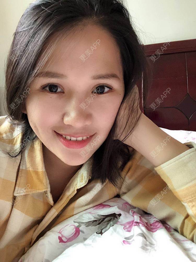 更美 - 更美用户R6xSXj7DGy的埋线提升经验 | 埋线提升 | 广州