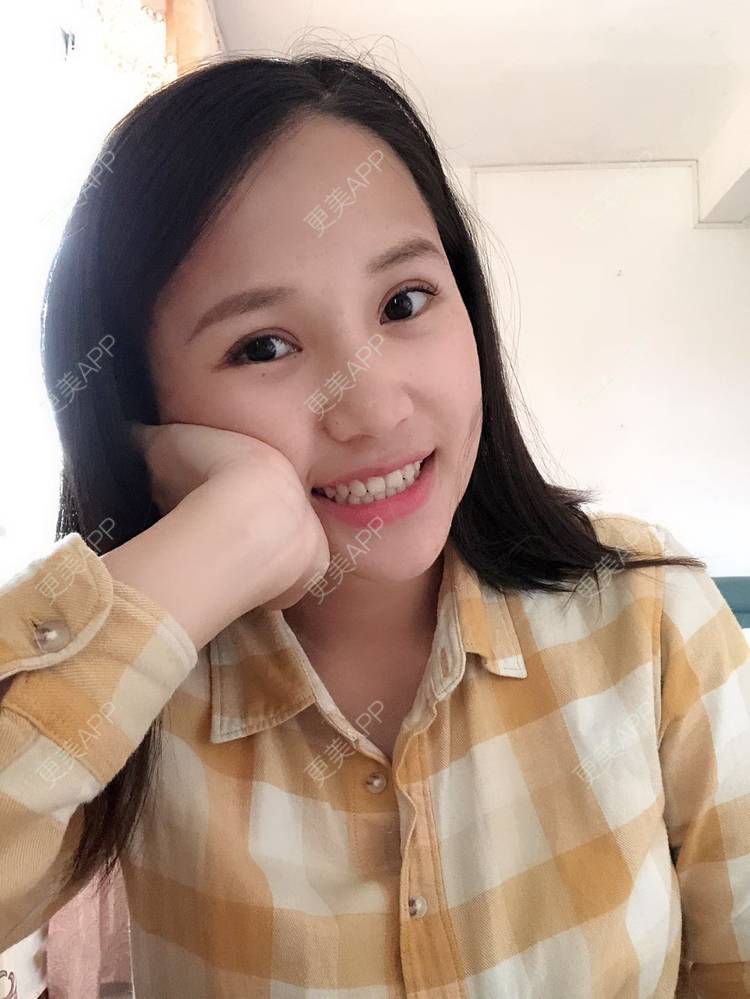 更美 - 更美用户R6xSXj7DGy的埋线提升经验 | 埋线提升 | 广州
