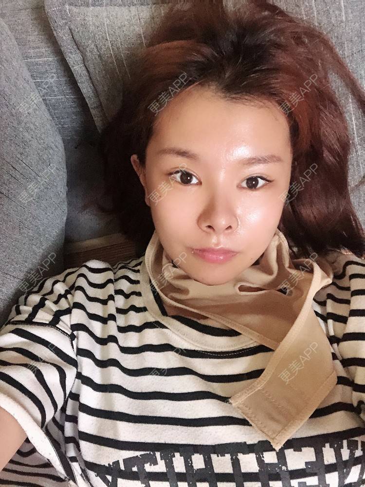 更美 - 更美用户WOuVgkC9NU的颧骨内推经验 | 颧骨内推 | 成都 | 颧弓降低