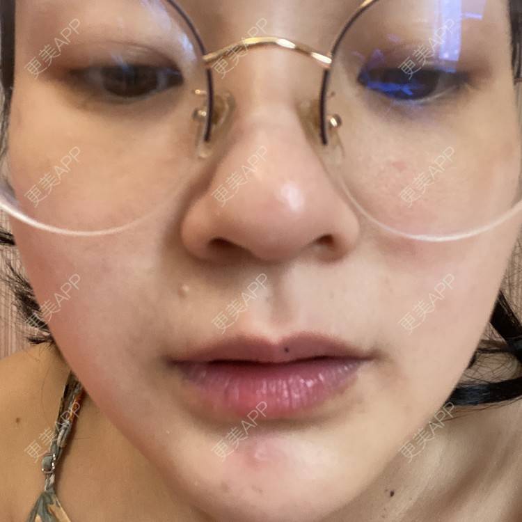 更美 - 一白遮三丑丑丑的激光淡斑经验 | 上海 | 激光淡斑 | 皮秒激光 | 淡斑套餐