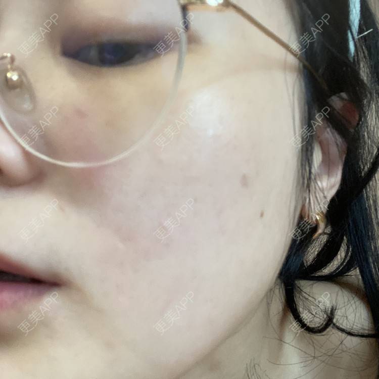 更美 - 一白遮三丑丑丑的激光淡斑经验 | 上海 | 激光淡斑 | 皮秒激光 | 淡斑套餐