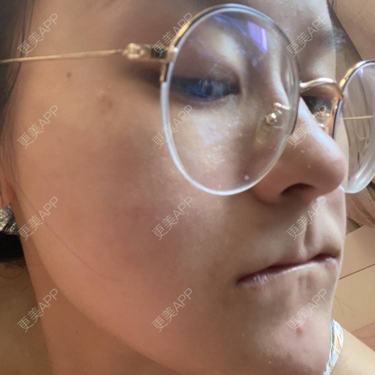 更美 - 一白遮三丑丑丑的激光淡斑经验 | 上海 | 激光淡斑 | 皮秒激光 | 淡斑套餐