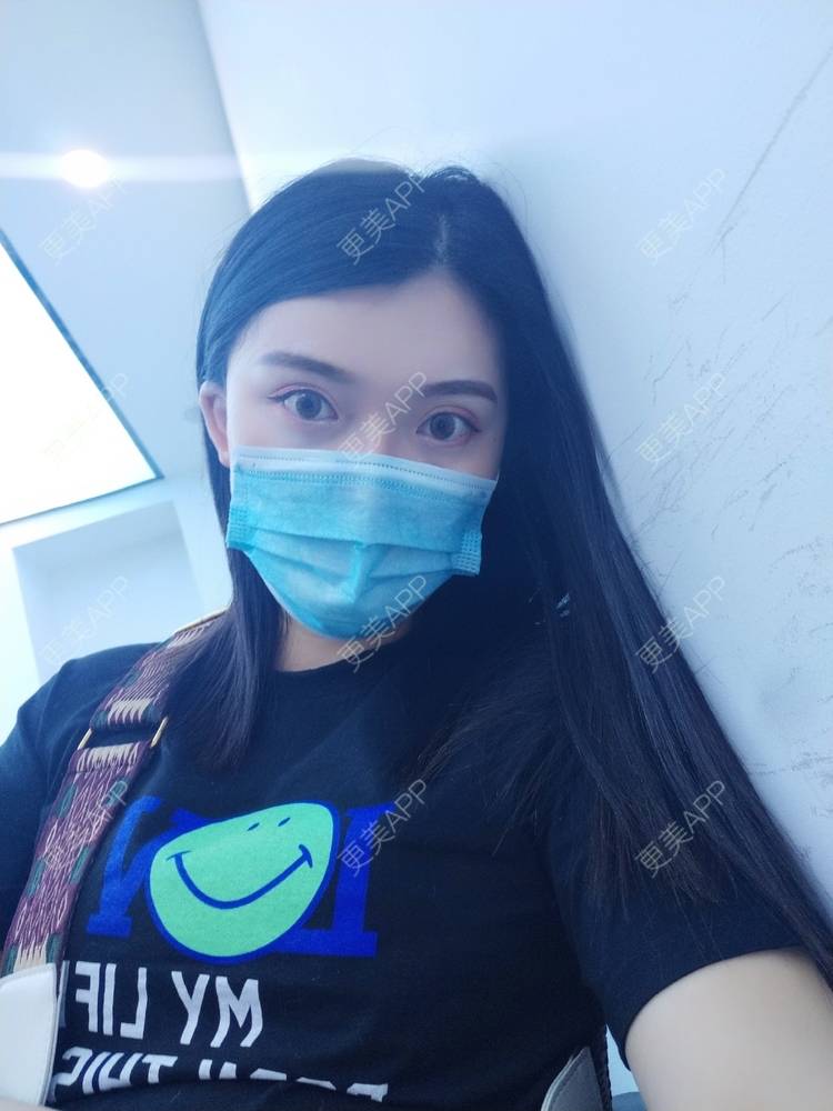 更美 - 璀璨太阳花骨朵的双眼皮修复经验 | 双眼皮修复 | 全切双眼皮 | 合肥 | 上眼睑去脂 | 开眼角修复