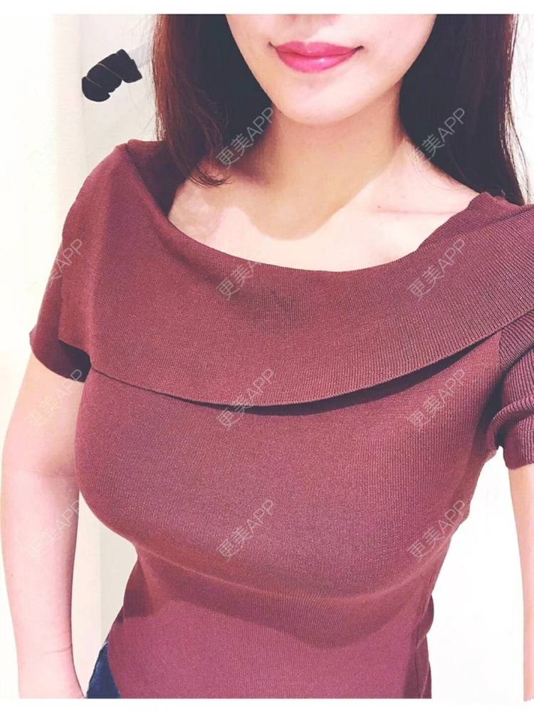 更美 - Cat帅的假体隆胸经验 | 假体隆胸 | 南昌