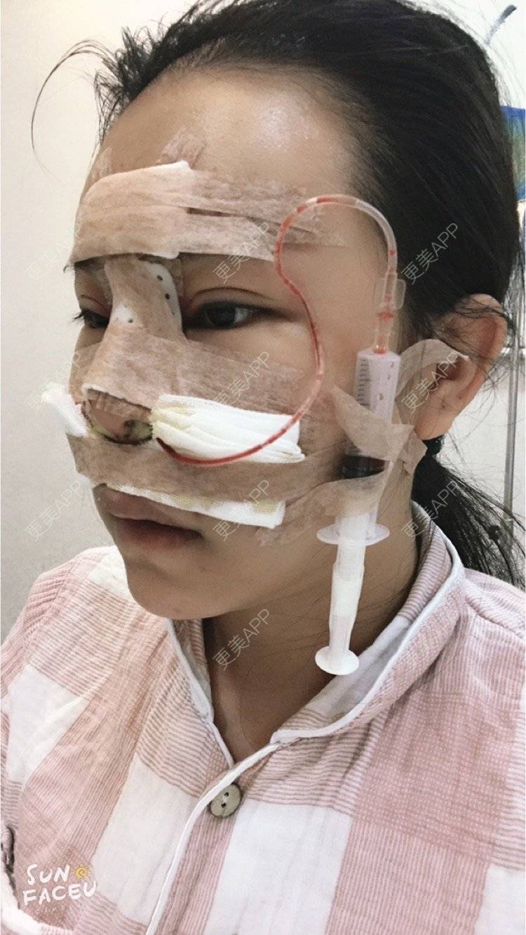 更美 - 更美用户iuB00h31N3的鼻部多项经验 | 鼻部多项 | 广州