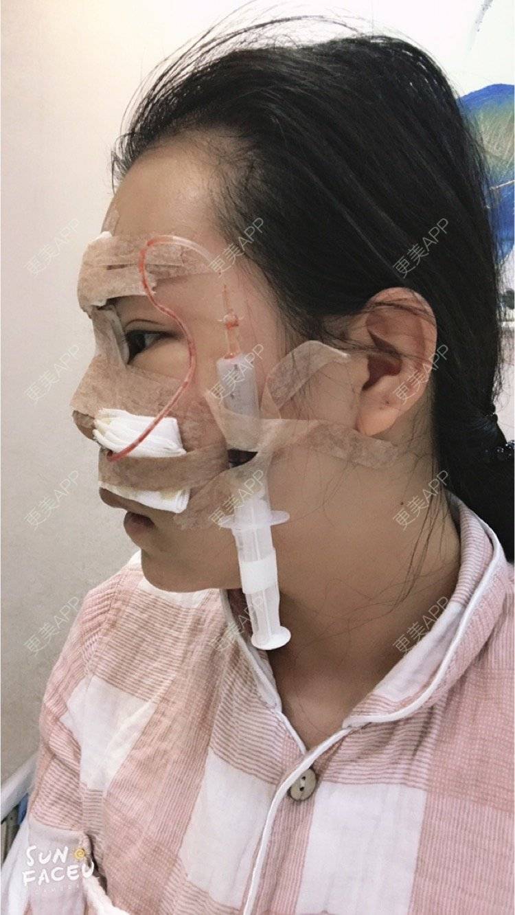更美 - 更美用户iuB00h31N3的鼻部多项经验 | 鼻部多项 | 广州