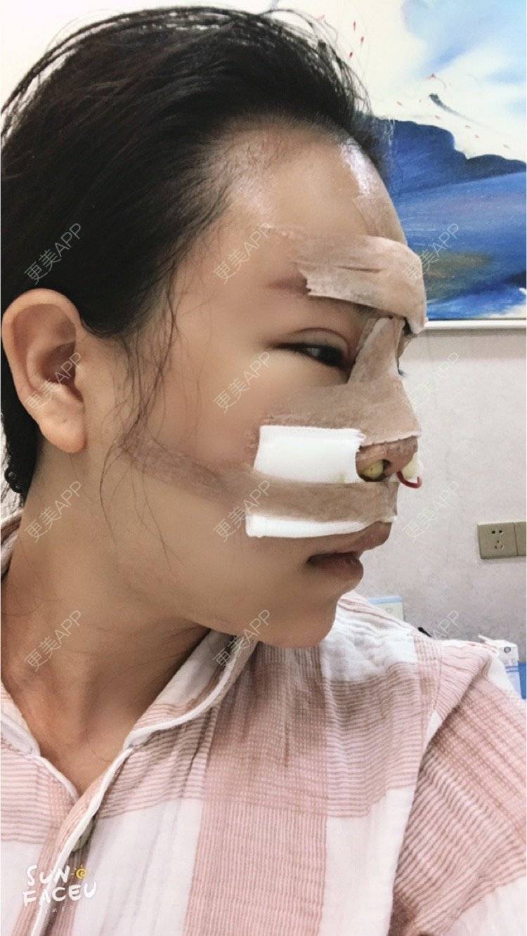 更美 - 更美用户iuB00h31N3的鼻部多项经验 | 鼻部多项 | 广州